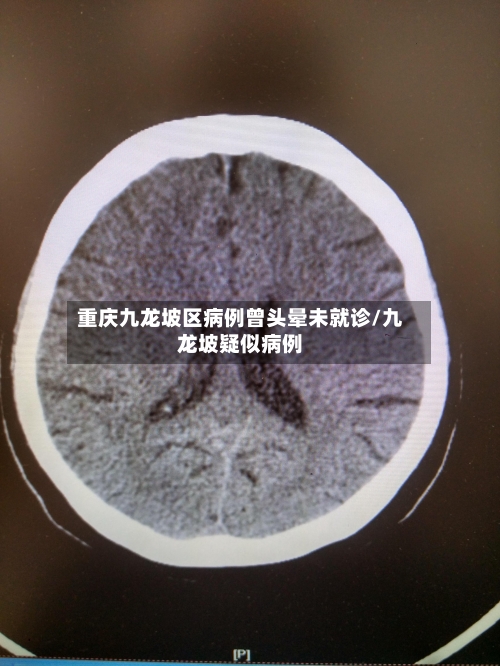 重庆九龙坡区病例曾头晕未就诊/九龙坡疑似病例-第3张图片