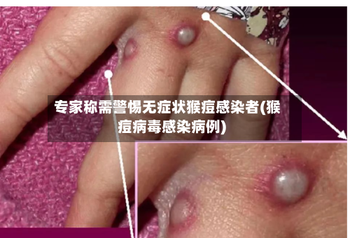 专家称需警惕无症状猴痘感染者(猴痘病毒感染病例)-第2张图片